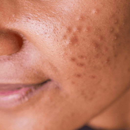 The Founder's Complete Guide to Adult Acne