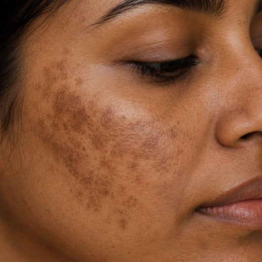 Why melasma keeps coming back?  What to do about it - Causes, Treatments and Prevention.