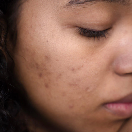 Breakouts this Summer? Here's How to Prevent Them