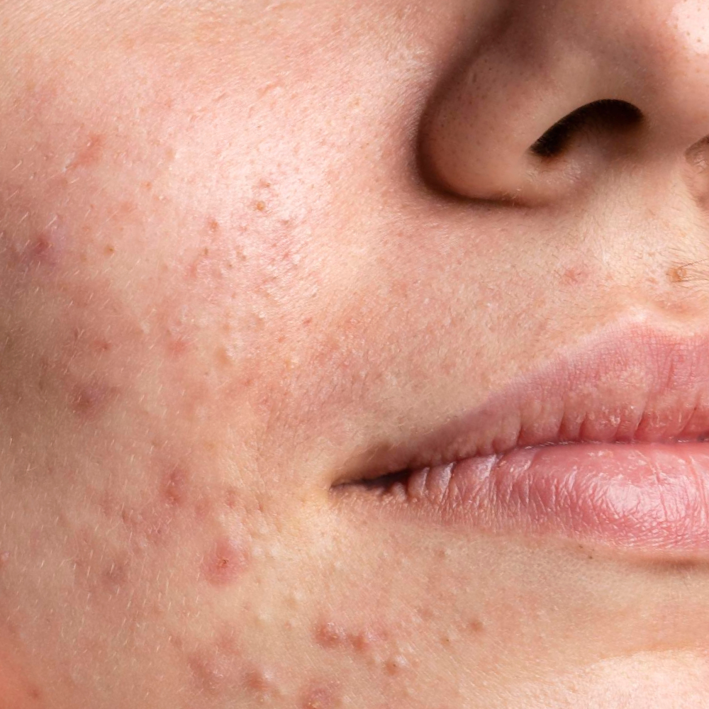 Breakouts and texture