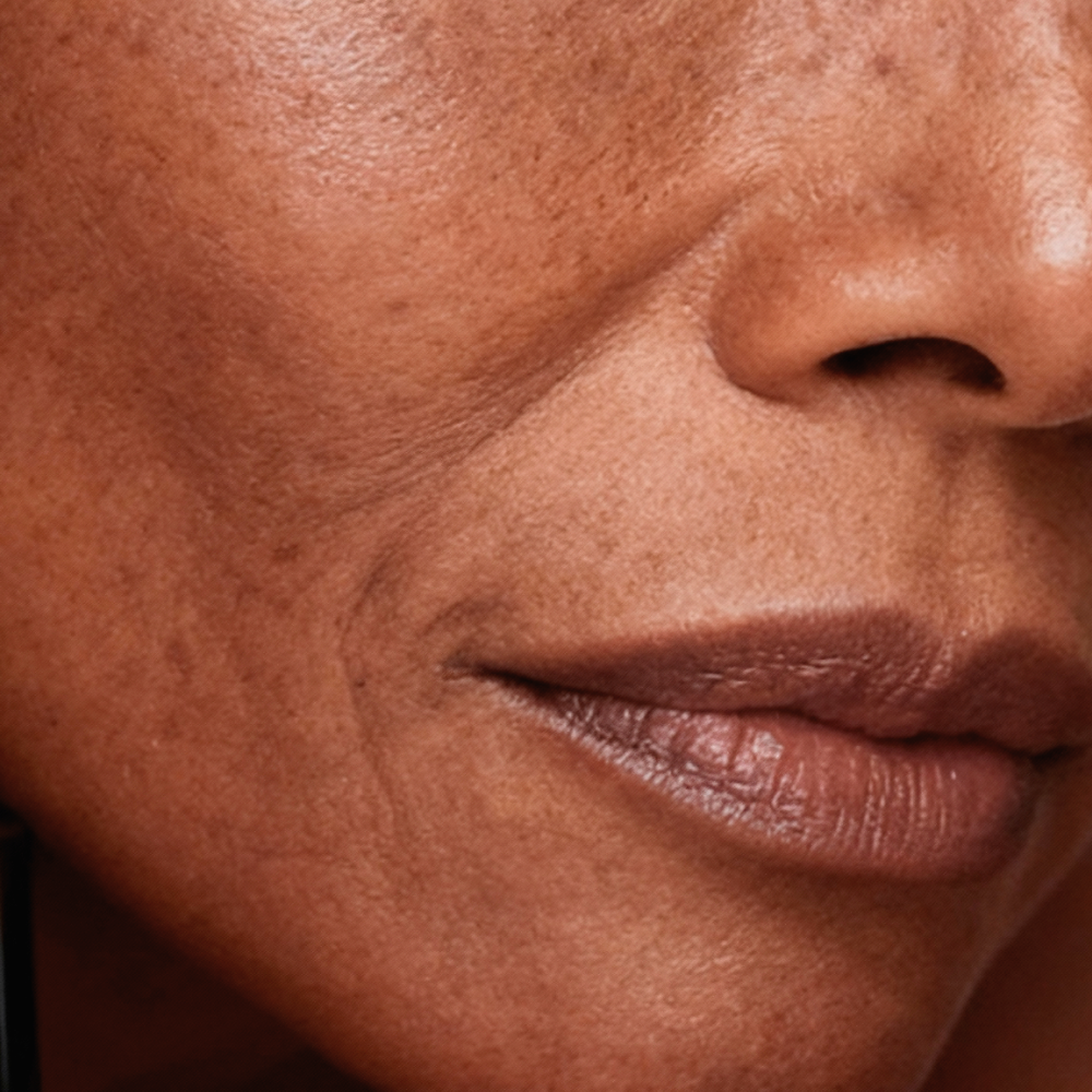 Hyper-pigmentation